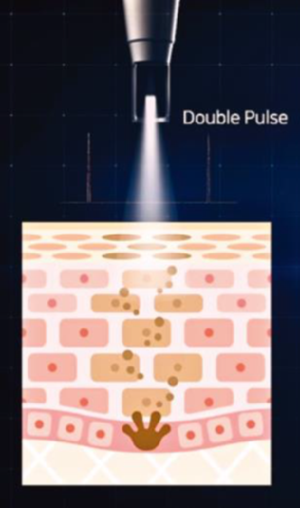 Double pulse treatment visual