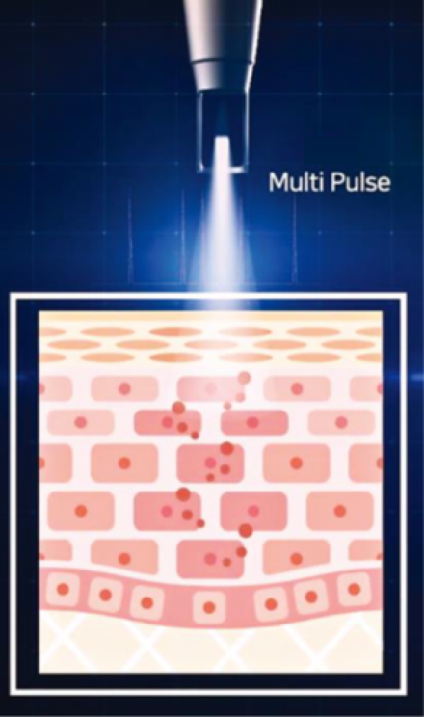 Multi pulse treatment visual