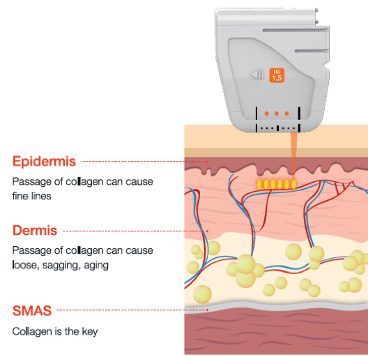 1.5 millimeter facial cartridge transmission depth diagram