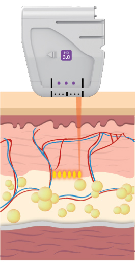 3.0 millimeter facial cartridge transmission depth diagram